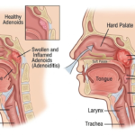 Adenoidid